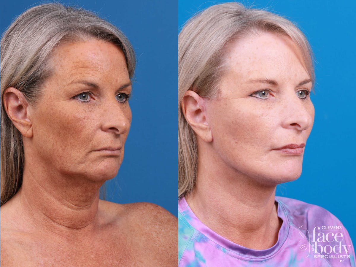 Eyelid Surgery Before & After Gallery - Patient 419045 - Image 2