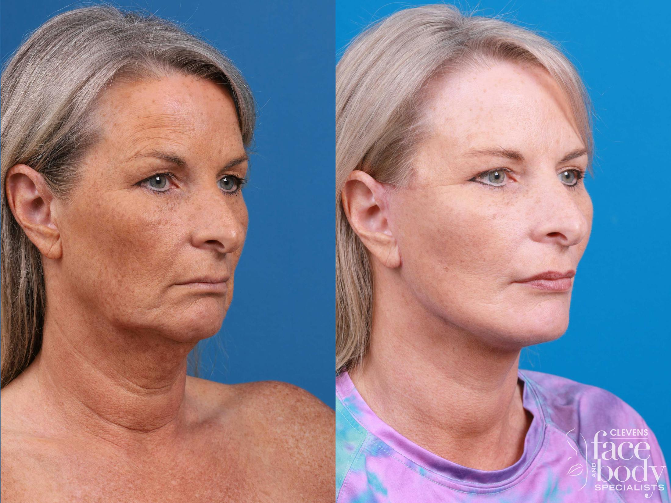 Eyelid Surgery Before & After Gallery - Patient 419045 - Image 2