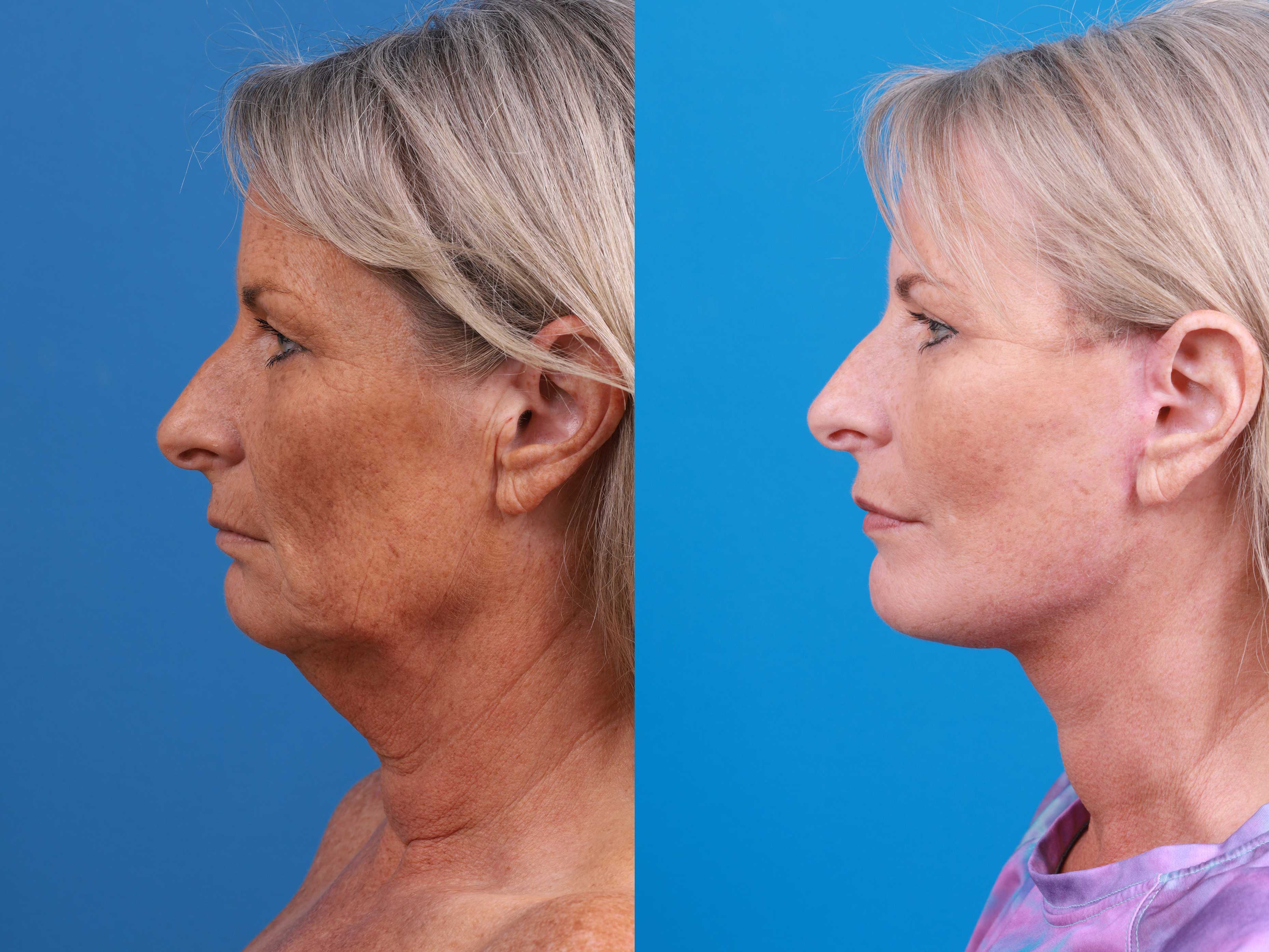 Eyelid Surgery Before & After Gallery - Patient 419045 - Image 4
