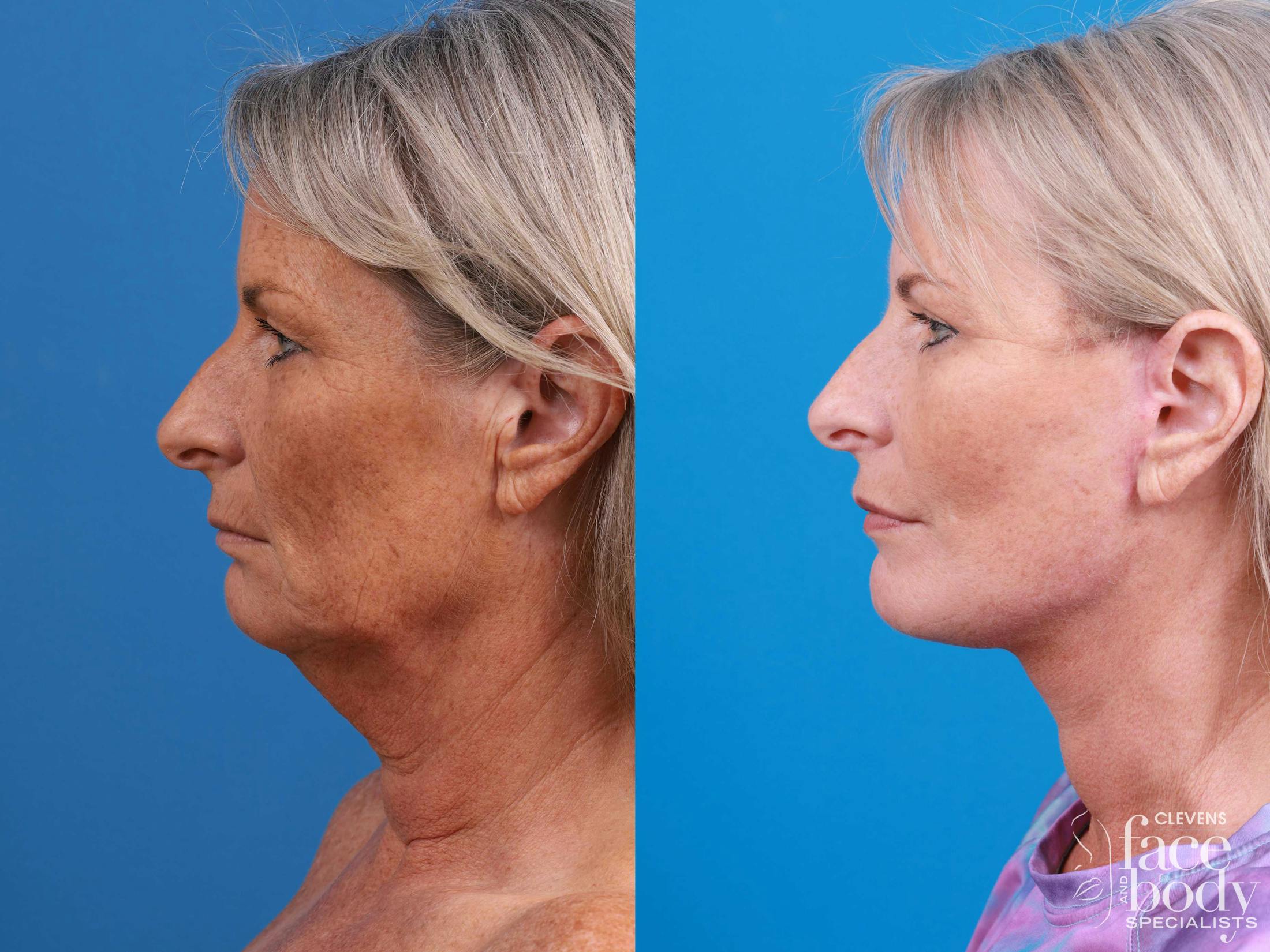 Eyelid Surgery Before & After Gallery - Patient 419045 - Image 4