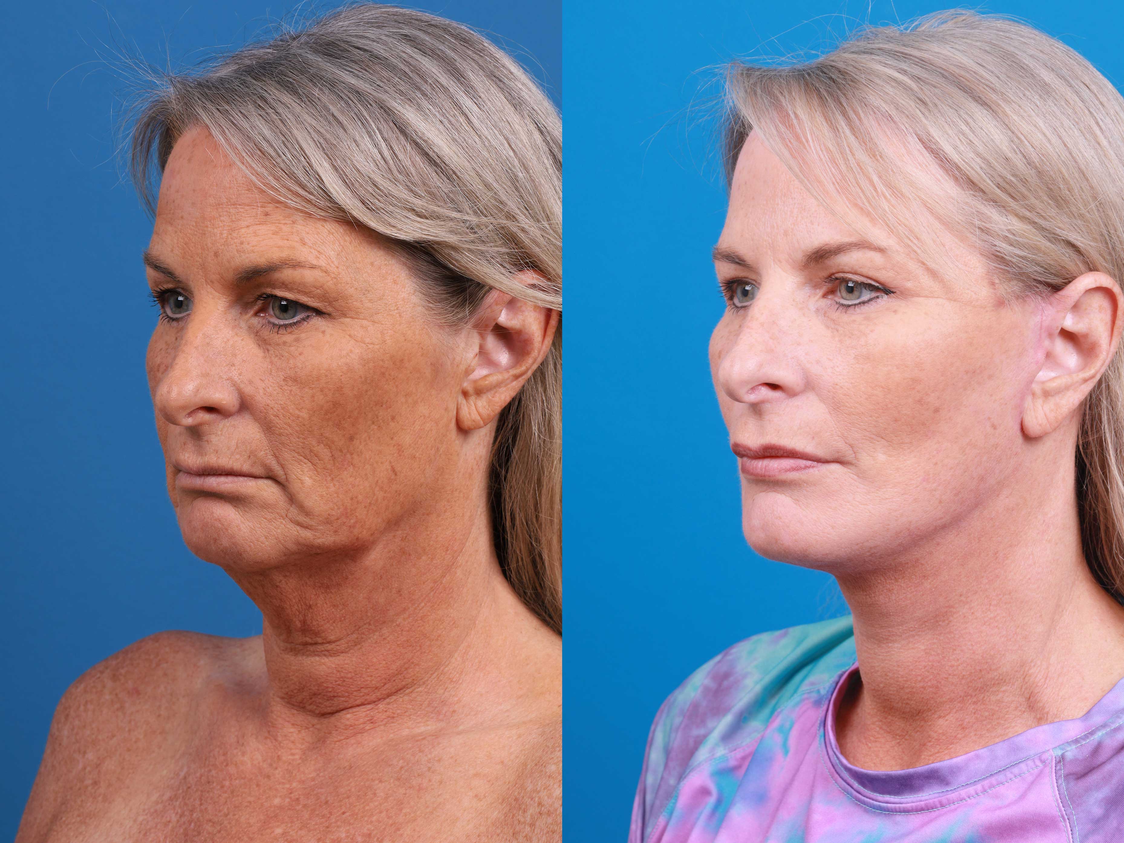 Eyelid Surgery Before & After Gallery - Patient 419045 - Image 5