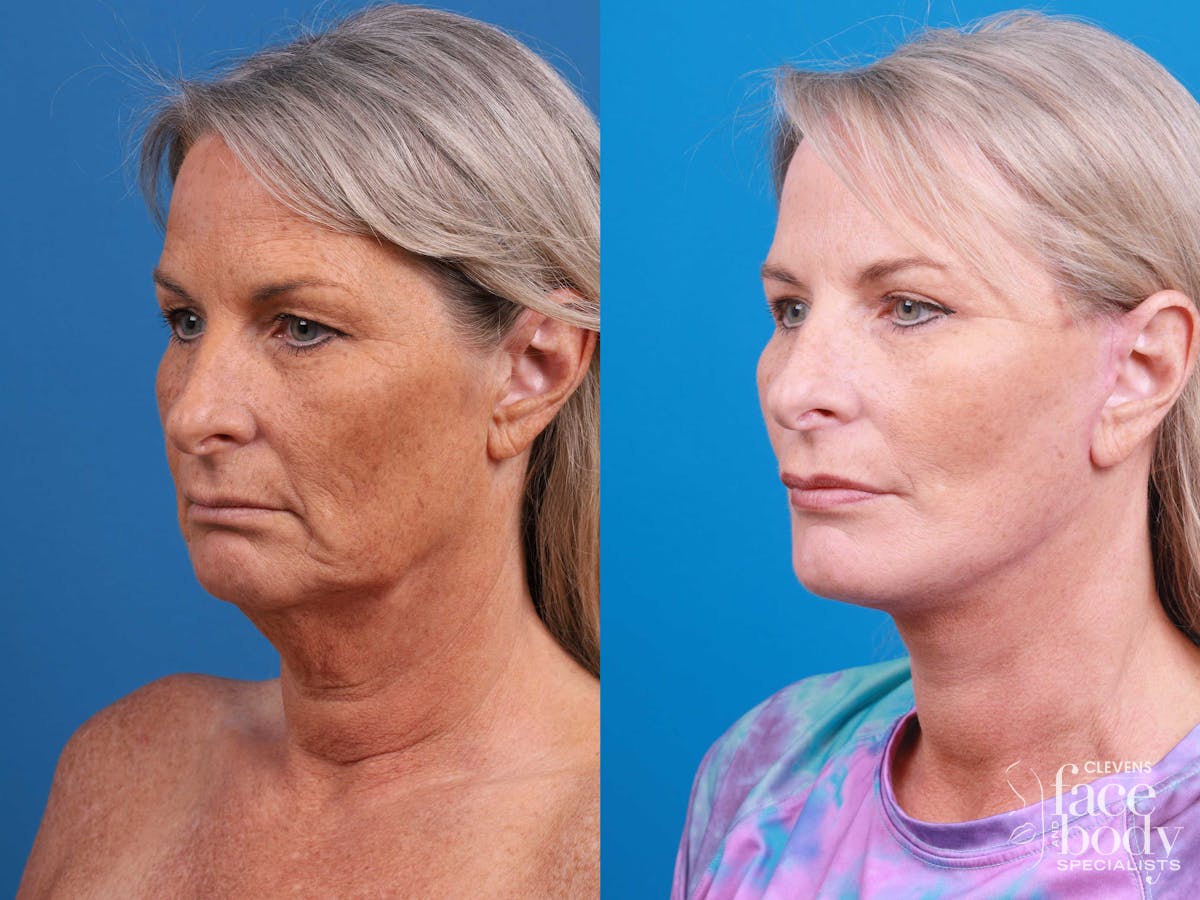 Eyelid Surgery Before & After Gallery - Patient 419045 - Image 5