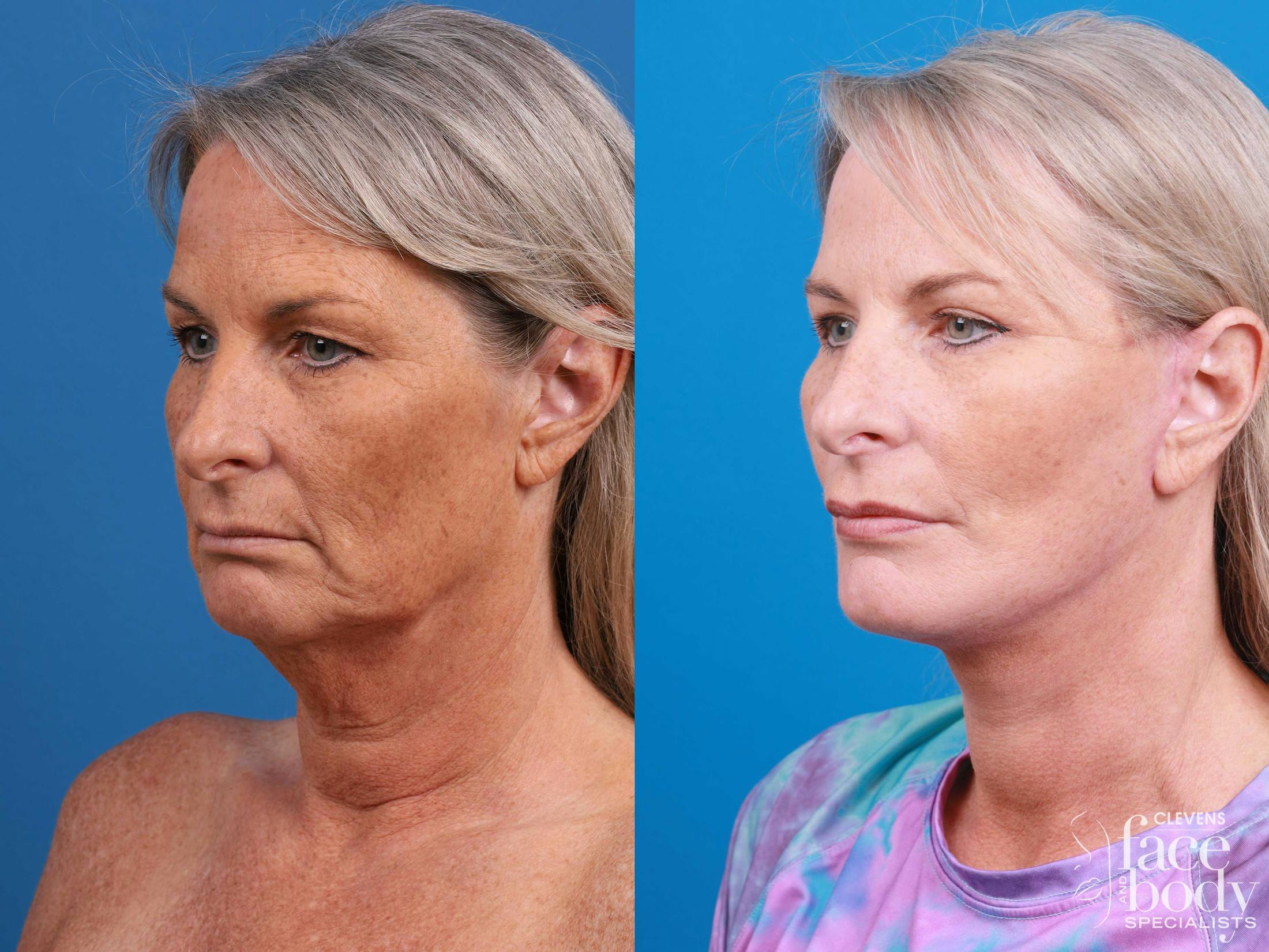 Eyelid Surgery Before & After Gallery - Patient 419045 - Image 5