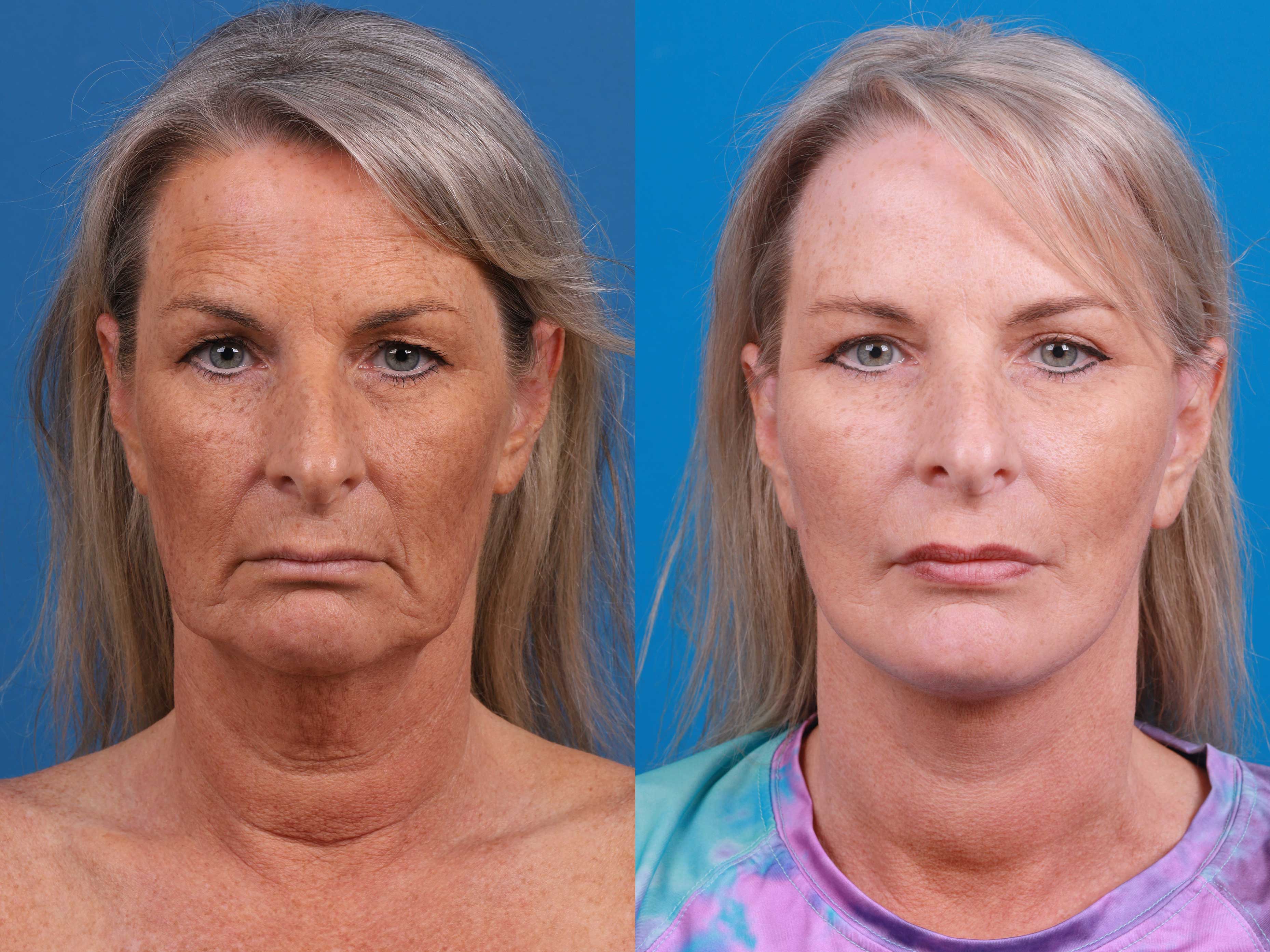 Eyelid Surgery Before & After Gallery - Patient 419045 - Image 1