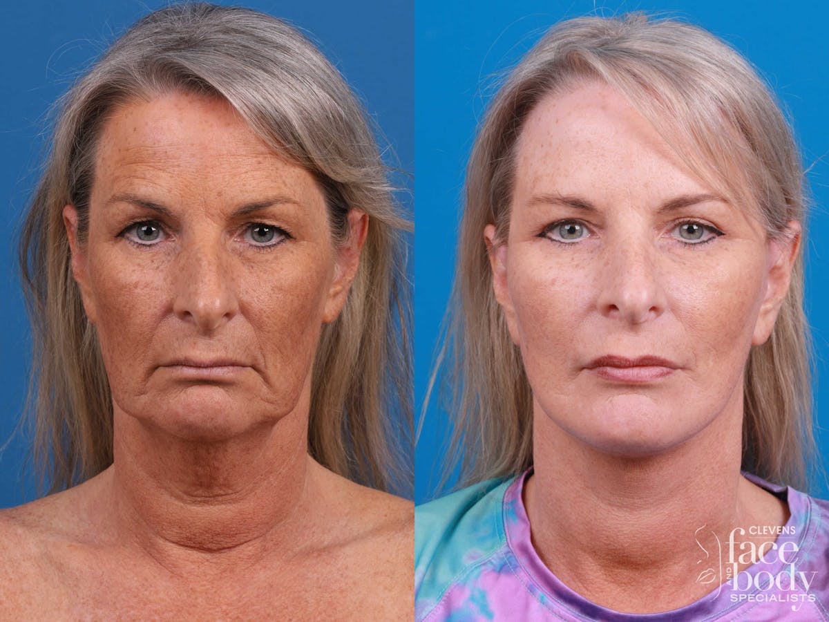 Eyelid Surgery Before & After Gallery - Patient 419045 - Image 1