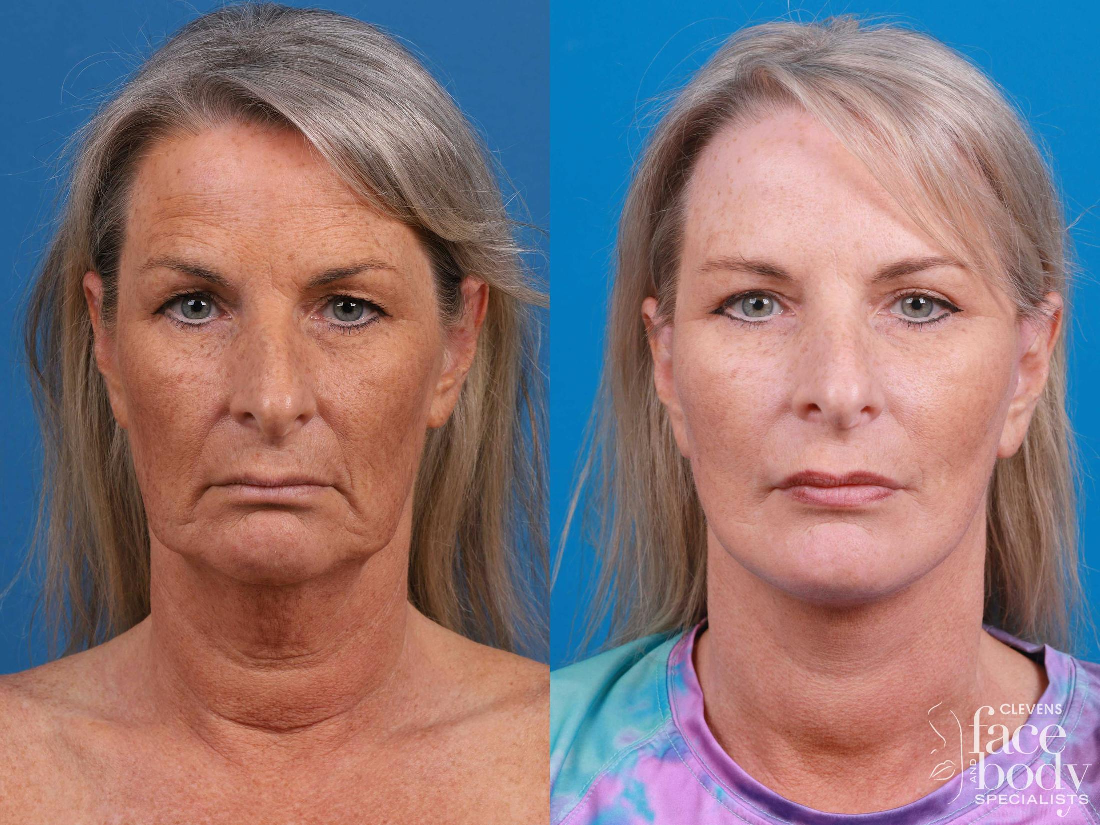 Eyelid Surgery Before & After Gallery - Patient 419045 - Image 1