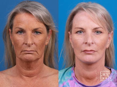 Eyelid Surgery Before & After Gallery - Patient 419045 - Image 1