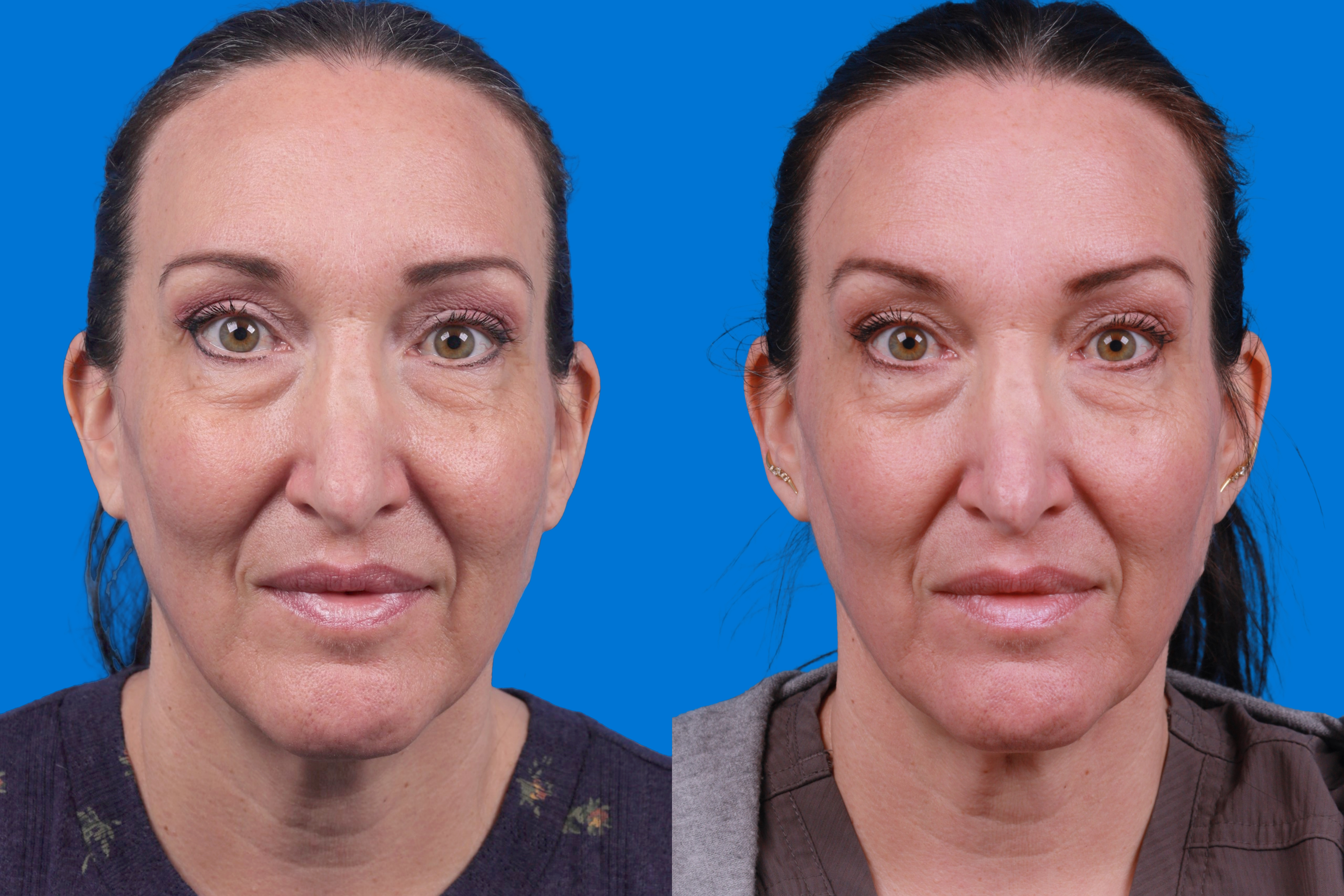 Morpheus8 Before & After Gallery - Patient 101722 - Image 1