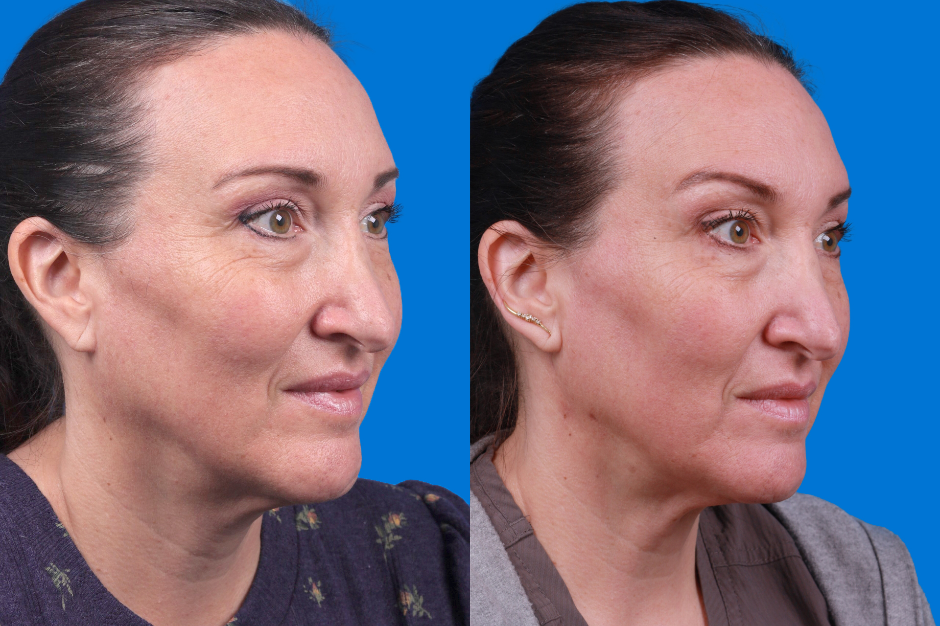 Morpheus8 Before & After Gallery - Patient 101722 - Image 2