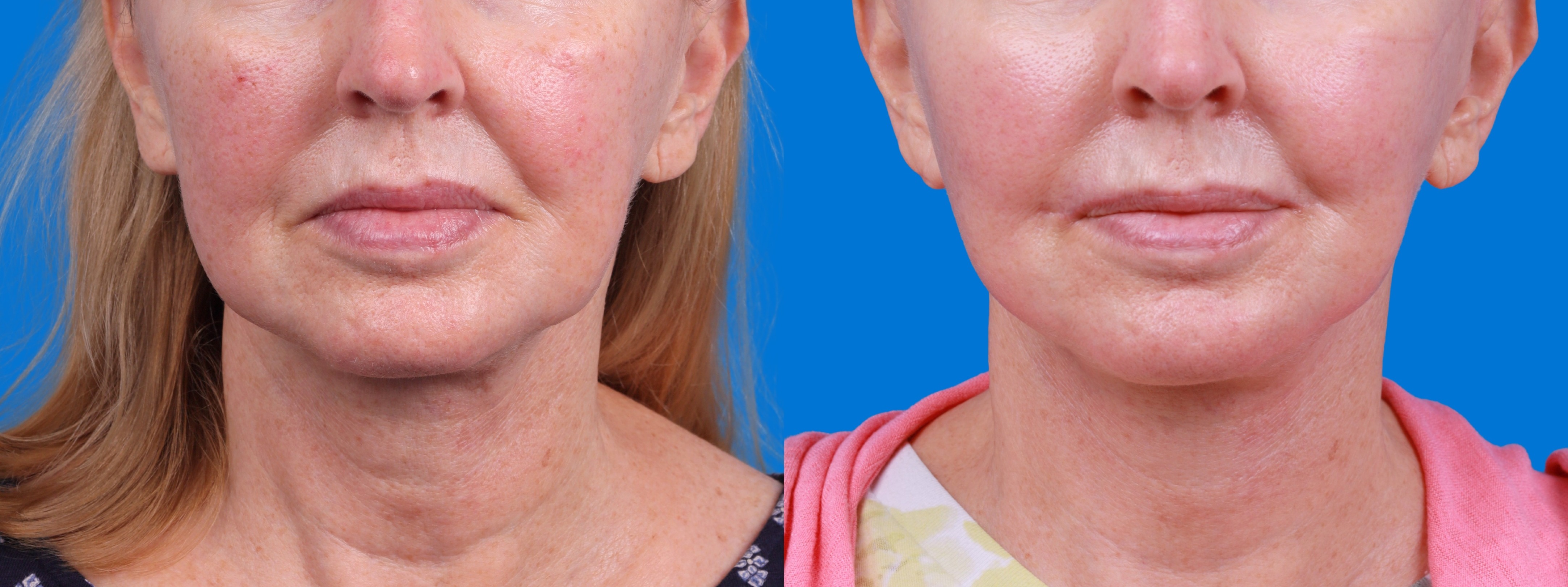Lip Lift Before & After Gallery - Patient 980056 - Image 1