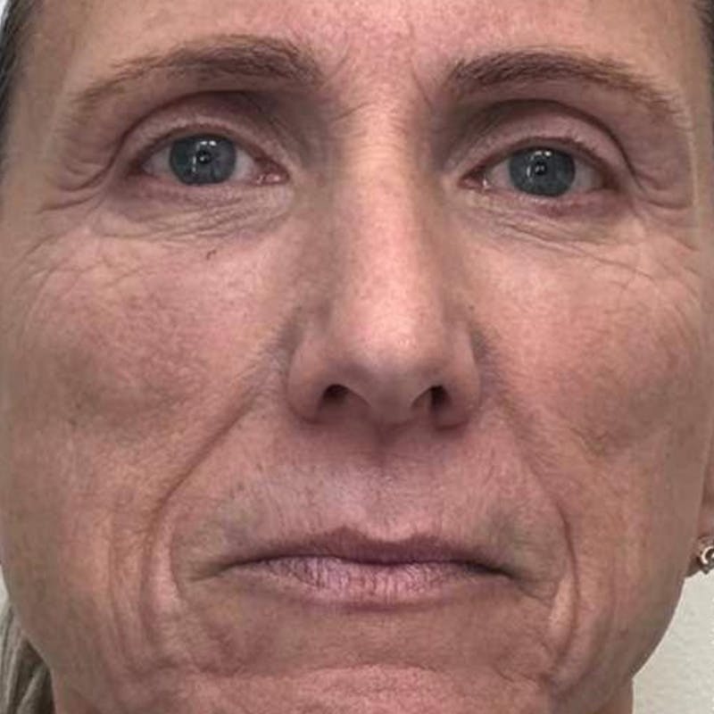 Junera Before & After Gallery - Patient 450860 - Image 1