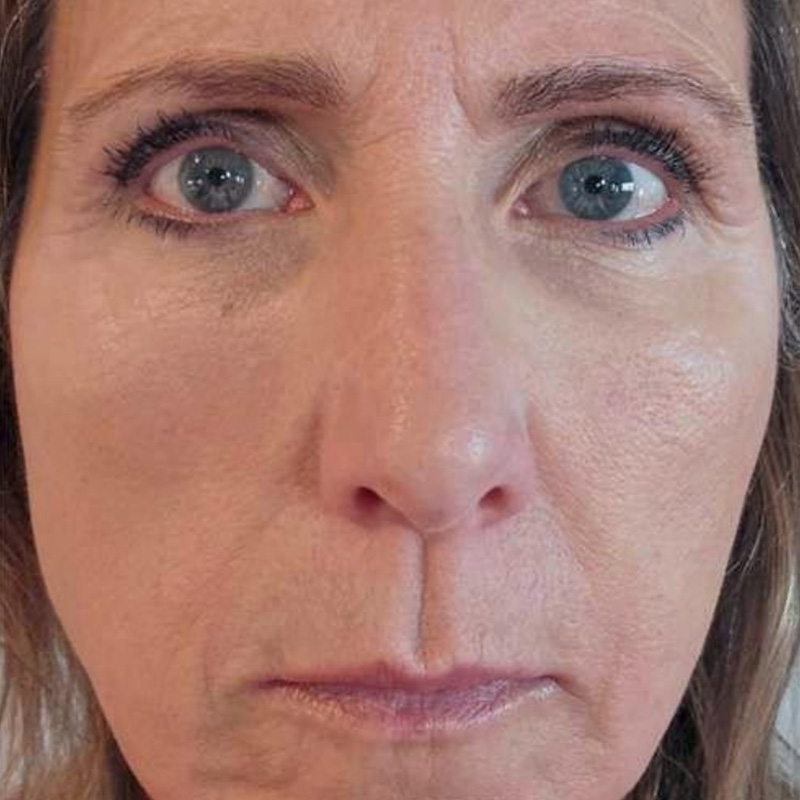 Junera Before & After Gallery - Patient 450860 - Image 2
