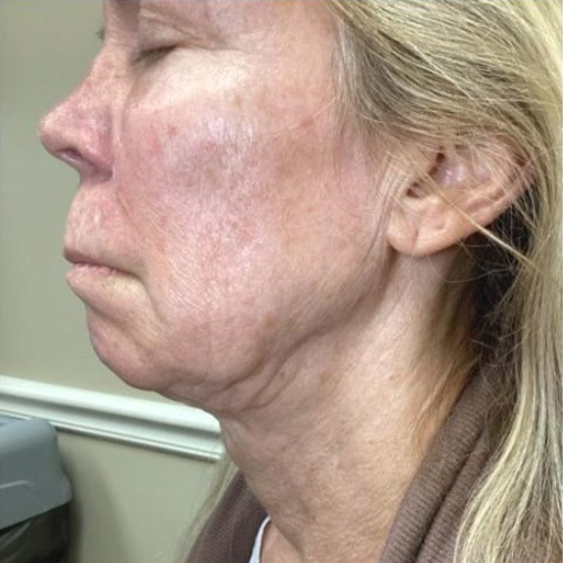 Junera Before & After Gallery - Patient 242891 - Image 1