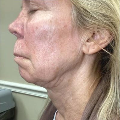 Junera Before & After Gallery - Patient 242891 - Image 1