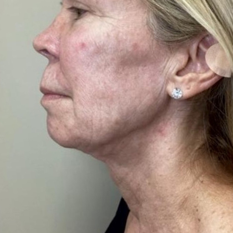 Junera Before & After Gallery - Patient 242891 - Image 2