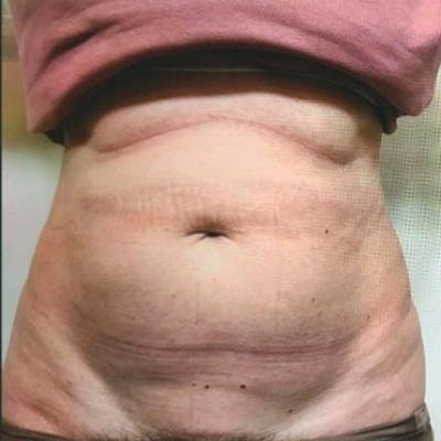 Junera Before & After Gallery - Patient 305651 - Image 1