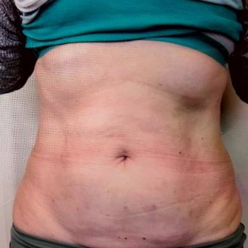 Junera Before & After Gallery - Patient 305651 - Image 2