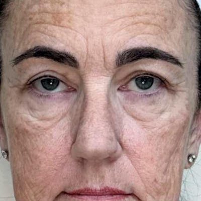 Junera Before & After Gallery - Patient 245139 - Image 1