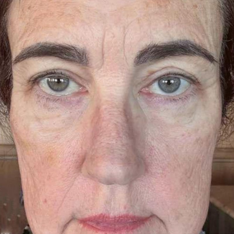 Junera Before & After Gallery - Patient 245139 - Image 2