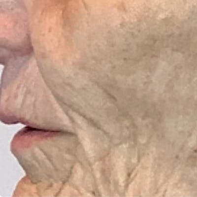 Junera Before & After Gallery - Patient 348575 - Image 1