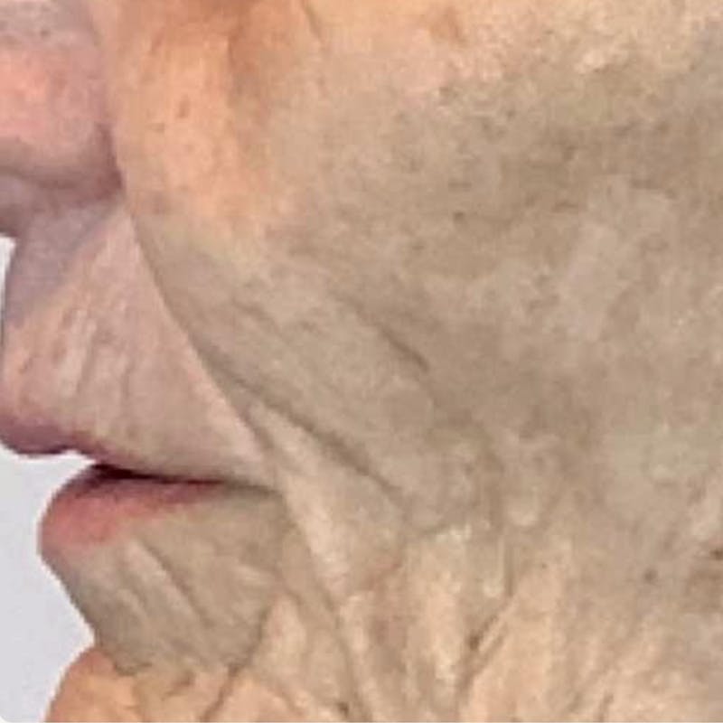 Junera Before & After Gallery - Patient 348575 - Image 1