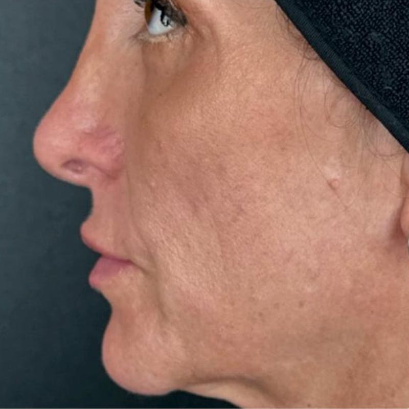Junera Before & After Gallery - Patient 413286 - Image 1