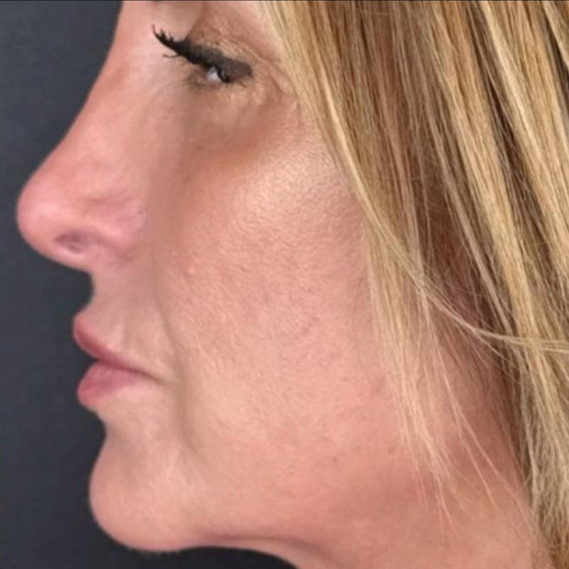 Junera Before & After Gallery - Patient 413286 - Image 2