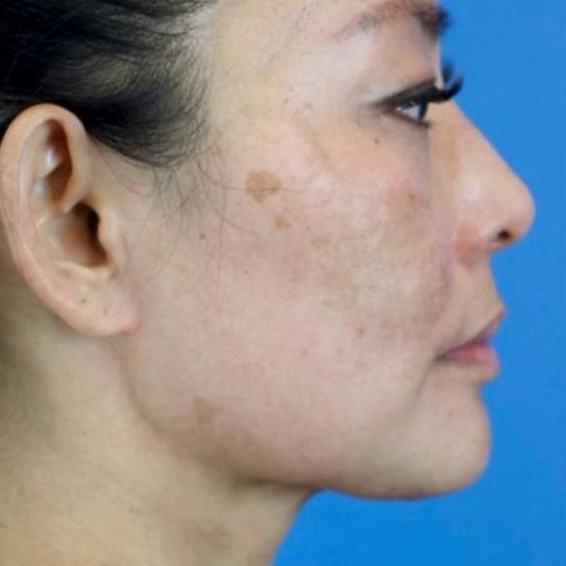 Junera Before & After Gallery - Patient 270565 - Image 1