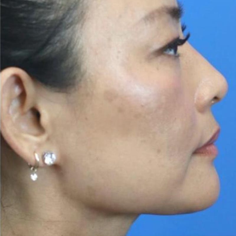 Junera Before & After Gallery - Patient 270565 - Image 2