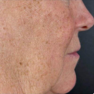 Junera Before & After Gallery - Patient 218408 - Image 1