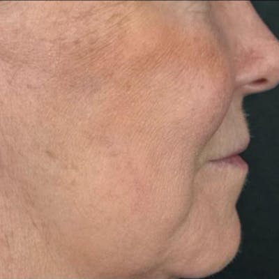 Junera Before & After Gallery - Patient 218408 - Image 2