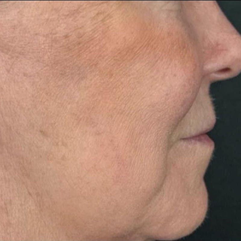 Junera Before & After Gallery - Patient 218408 - Image 2