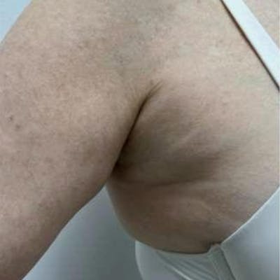 Junera Before & After Gallery - Patient 374205 - Image 1