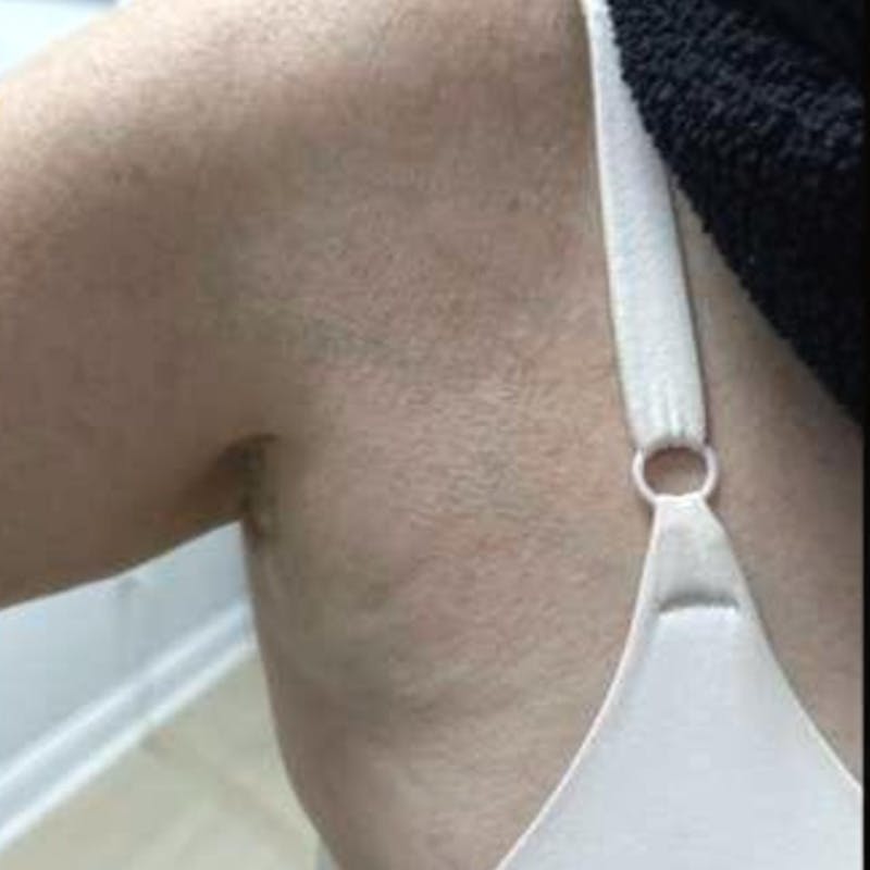 Junera Before & After Gallery - Patient 374205 - Image 2