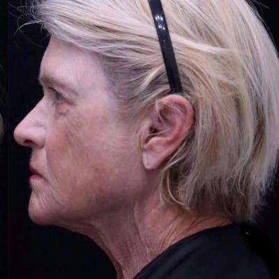 Junera Before & After Gallery - Patient 100427 - Image 2