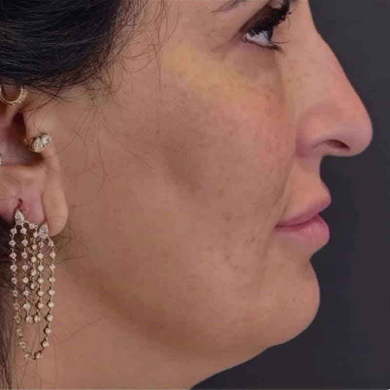 Junera Before & After Gallery - Patient 177156 - Image 1