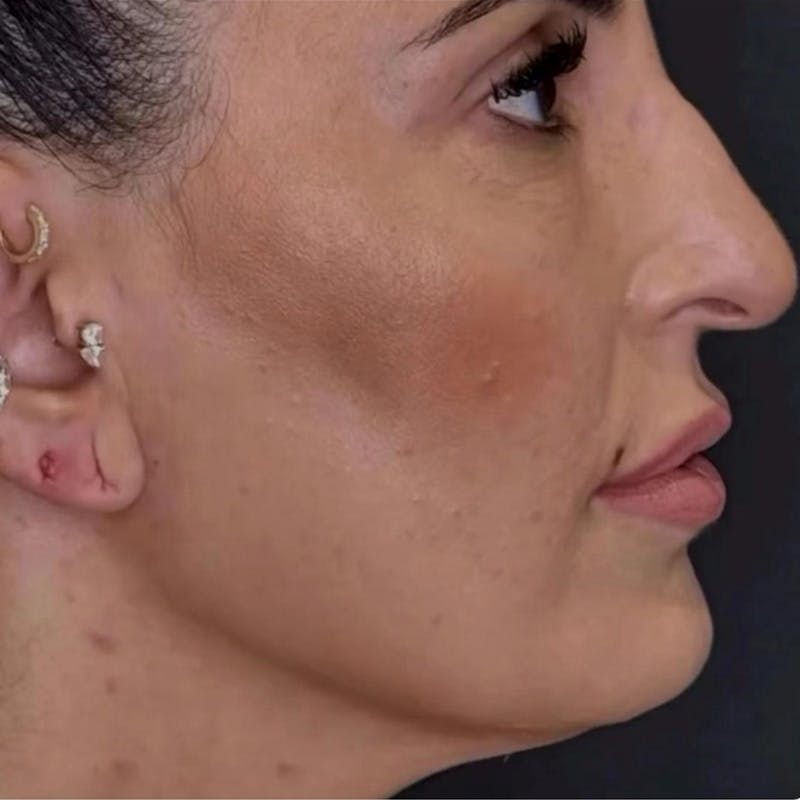 Junera Before & After Gallery - Patient 177156 - Image 2
