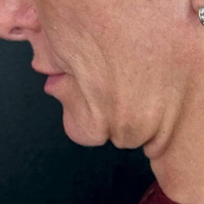Junera Before & After Gallery - Patient 942176 - Image 1