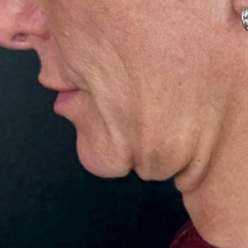 Junera Before & After Gallery - Patient 942176 - Image 1