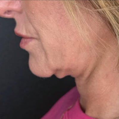 Junera Before & After Gallery - Patient 942176 - Image 2