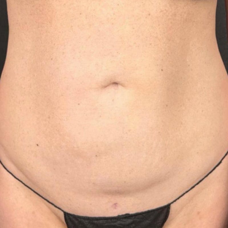 Junera Before & After Gallery - Patient 288865 - Image 1