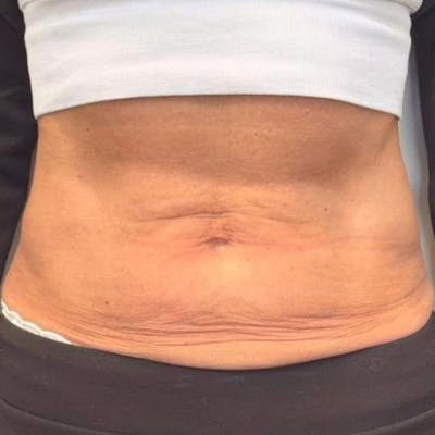 Junera Before & After Gallery - Patient 643846 - Image 1