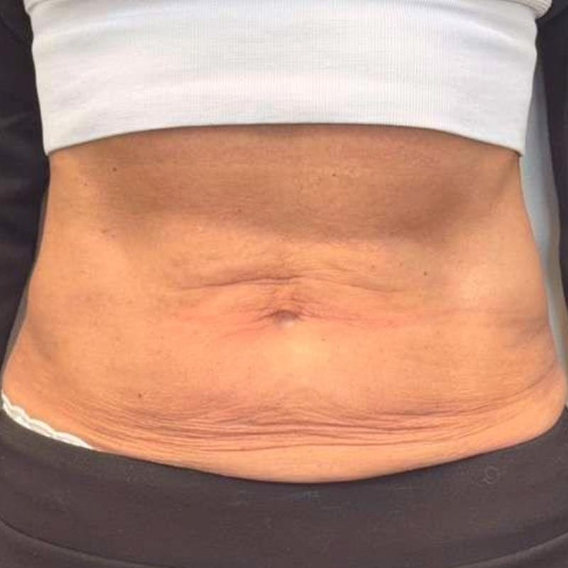 Junera Before & After Gallery - Patient 643846 - Image 1