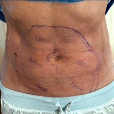 Junera Before & After Gallery - Patient 643846 - Image 2