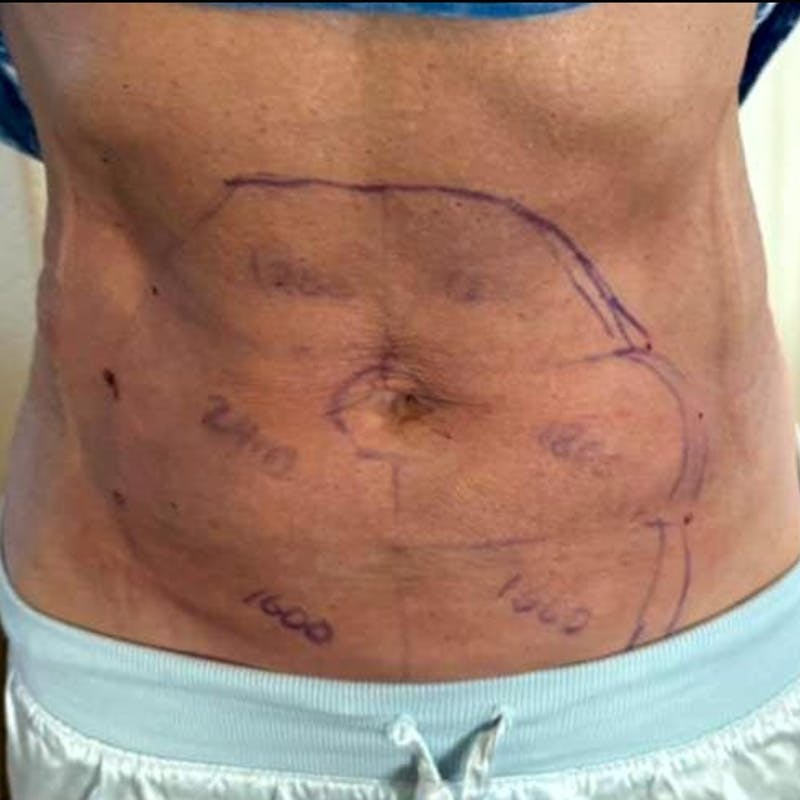 Junera Before & After Gallery - Patient 643846 - Image 2