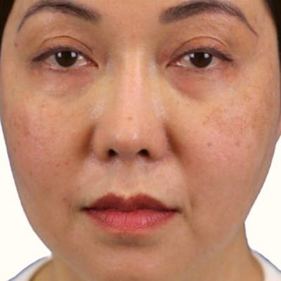 Junera Before & After Gallery - Patient 559577 - Image 1