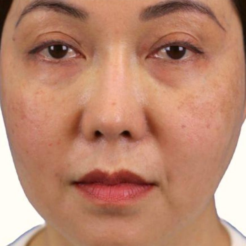 Junera Before & After Gallery - Patient 559577 - Image 1