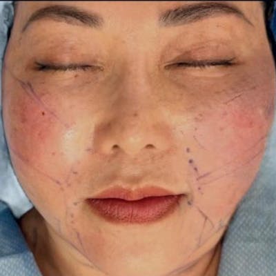 Junera Before & After Gallery - Patient 559577 - Image 2