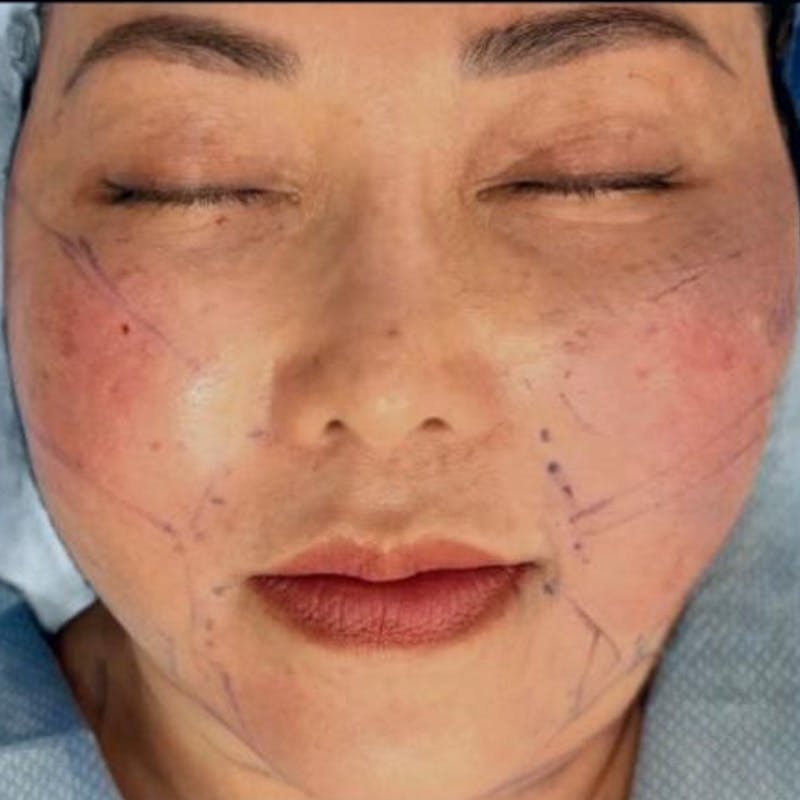 Junera Before & After Gallery - Patient 559577 - Image 2