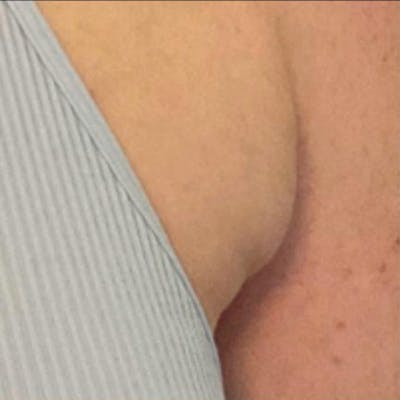 Junera Before & After Gallery - Patient 243355 - Image 1